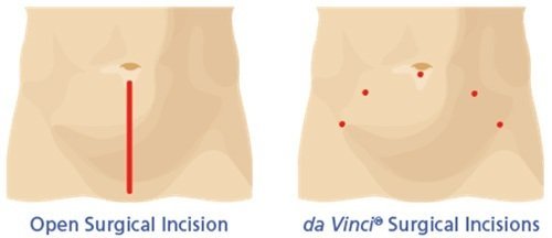 Surgical Incision